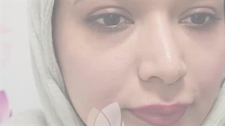 کاشت ابرو در کلینیک آوینا