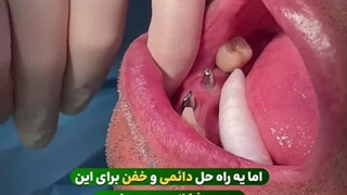 تحویل روکش ایمپلنت