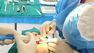 ایمپلنت دندان در دندانپزشکی دکتر حمید پورصادقی برداشتن خال