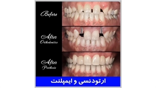 ارتودنسی و ایمپلنت