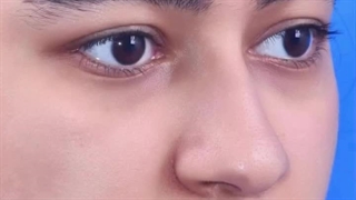 نمونه کار جراحی بینی توسط دکتر علی شفیعی