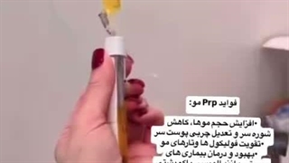درمان ریزش مو با کیت پی آر پی