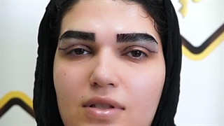 انجام کاشت ابرو و بلفاروپلاستی پلک به صورت همزمان