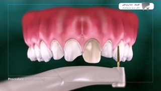 چطور لمینت دندان انجام می‌شود؟ نگاهی مرحله‌به‌مرحله به یک لبخند حرفه‌ای