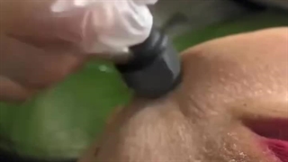 میکرودرم صورت در رشت