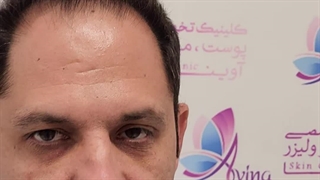 کاشت مو در کلینیک آوینا