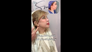 لیفت دیپ پلین صورت و گردن برای همکار گرامی