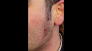 درمان لک ناشی از سوختگی با مزوژل بلامین