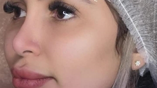 لیفت با نخ سیلوئت - دکتر علی پرتوی نژاد اصلاح فرم صورت