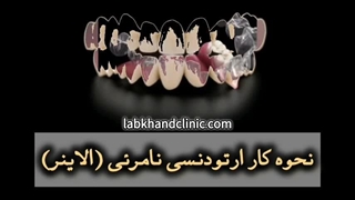 نحوه کار ارتودنسی نامرئی