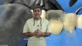 کامپوزیت دندان - مزایا و معایب آن