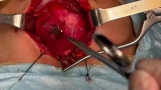 جراحی عصب ریکارنت لارنژال و پاراتیرویید