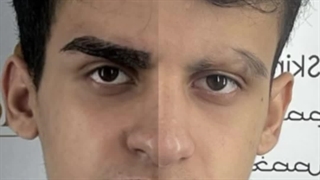 کاشت ابرو آقایان در کلینیک مانا