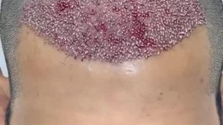 کاشت مو با خط رویش کاملا طبیعی