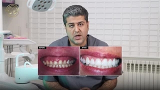 لیفت لثه چیست؟ معرفی روش و کاربرد