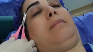 کاشت ابروی طبیعی در کلینیک تخصصی رنسانس