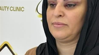 انجام همزمان کاشت ابرو و بلفاروپلاستی پلک