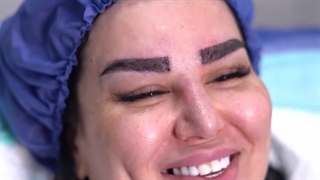 انجام کاشت ابرو بدون جراحی به روش sut در کلینیک رنسانس