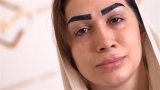 کاشت ابرو به روش انحصاری sut