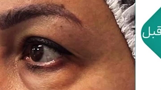 جراحی پلک در کلینیک تخصصی گونه