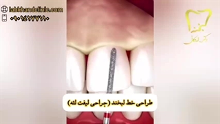 طراحی خط لبخند