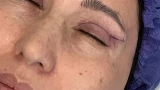 انجام بلفاروپلاستی پلک بالا با بخیه لیزری در کلینیک رنسانس