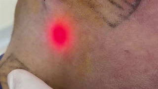 نحوه عملکرد لیزر جوانساز اندولیفت