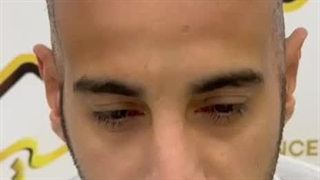 کاشت موی طبیعی با تراکم بالا در کلینیک رنسانس