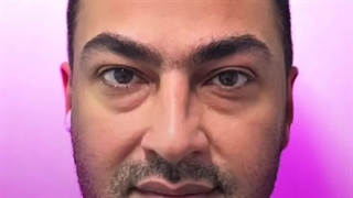 برداشتن پف زیر چشم در کلینیک گونه