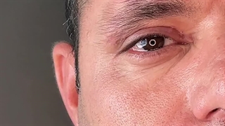 قبل و بعد بلفاروپلاستی پلک بالا پیلینگ شیمیایی