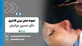 نمونه عمل بینی فانتزی با دکتر مرادیان در شیراز - پزشک 24