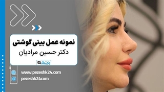 عمل بینی گوشتی با دکتر مرادیان در شیراز - پزشک 24