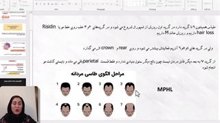 الگوی طاسی مردانه