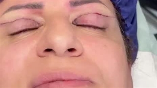 انجام بلفاروپلاستی پلک بالا در کلینیک زیبایی رنسانس