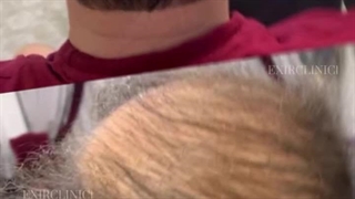 کاشت مو در یک جلسه در کلینیک اکسیر میدان ونک