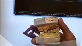 تحویل روکش های ایمپلنت کره ای