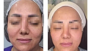 سمانه ابراهیمی پاکسازی پوست مشهد | سایت بهترین در مشهد