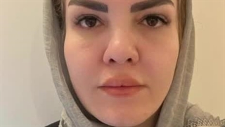 قبل و بعد از کاشت ابروی طبیعی