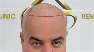 قبل و بعد از کاشت موی طبیعی