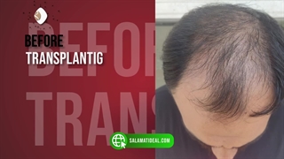 قبل و بعد از کاشت مو در کلینیک سلامت ایده آل