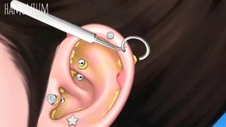 *Hamonium Asmr 2024*درمان جوش عفونی مجرای گوش-قسمت هفتم