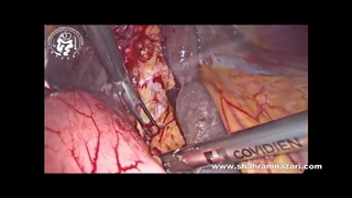 سندرم میریزی در عمل کیسه صفرا