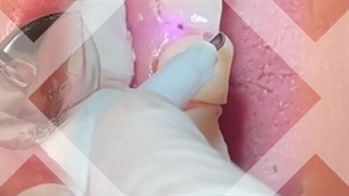 لیفت لثه با لیزر