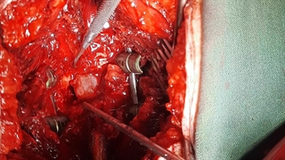 جراحی دیسک کمر و لغزندگی مهره