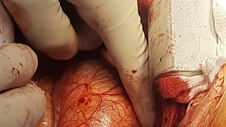 جراحی تعویض آئورت قلب بنتال قلب