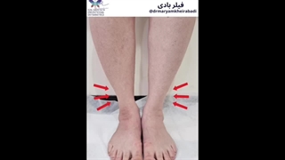 نمونه‌ای از تزریق فیلر ساق پا (1)