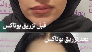 تزریق بوتاکس در کلینیک آوینا