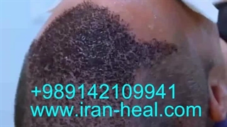 شلون نغسل الشعر المزروع؟ نصایح العنایة بعد زراعة الشعر