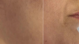 قبل و بعد از ساکشن غبغب