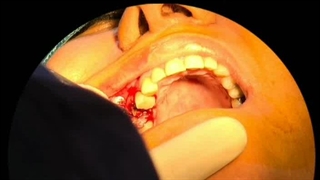 کاشت دندان اقساطی توسط دکتر حمید پورصادقی